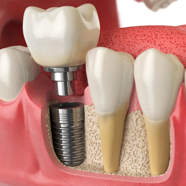 Implante dentário